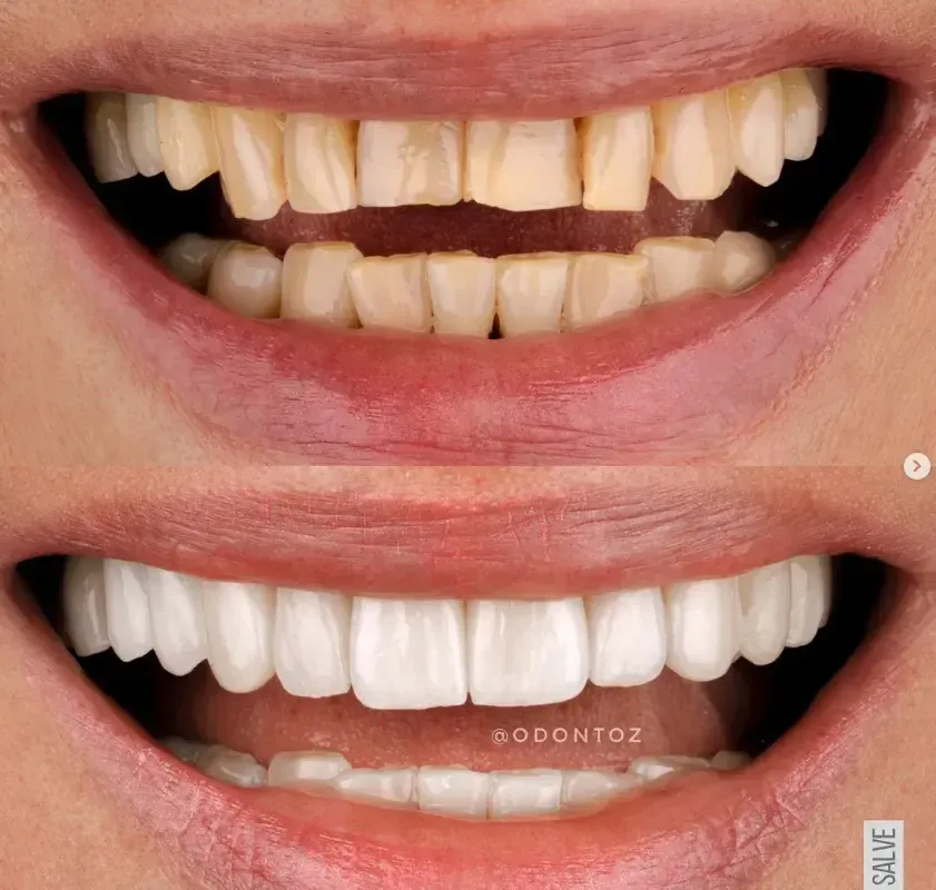 Alinhador invisível ortodôntico transparente
