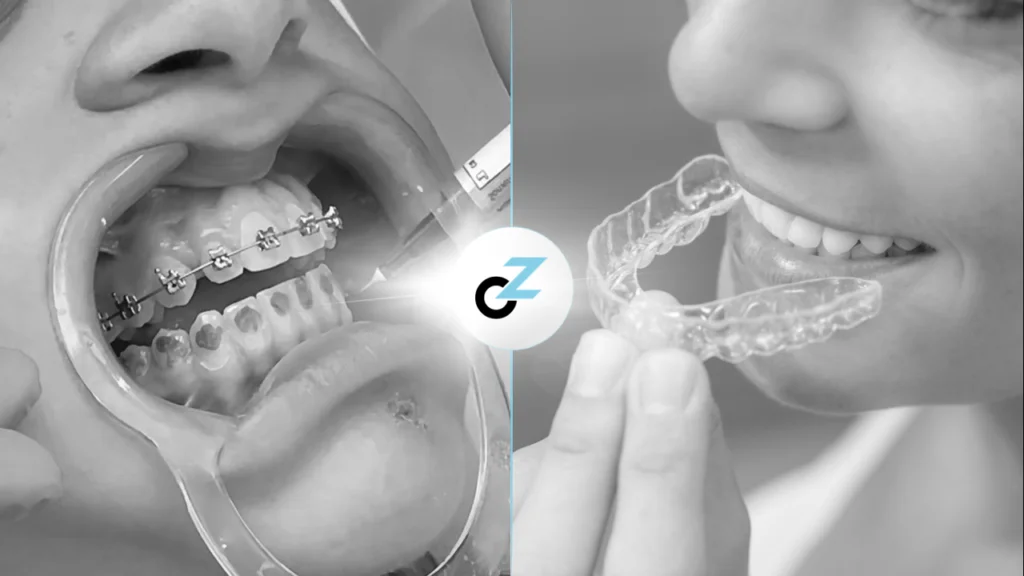 Aparelho Fixo ou Invisível: como escolher o melhor?