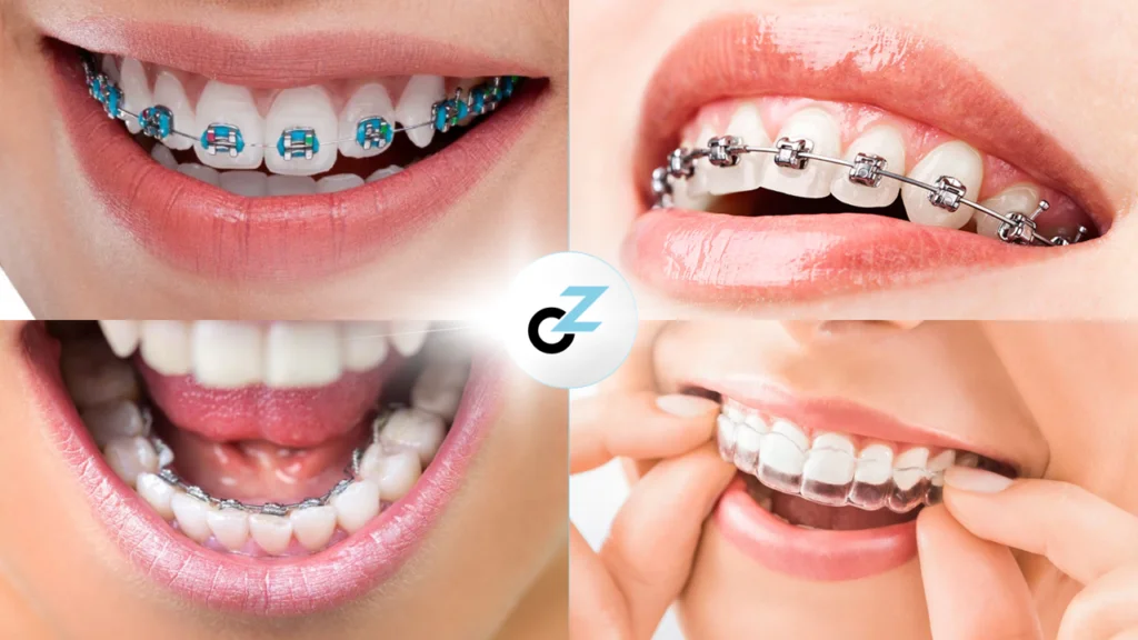 Aparelho Invisível ou Comum: qual a diferença entre eles?