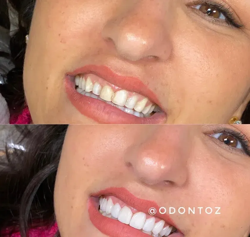 Aparelho ortodôntico metálico convencional fixado nos dentes