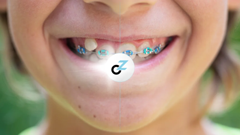 Aparelho Ortodôntico em Crianças: 15 Benefícios Reais