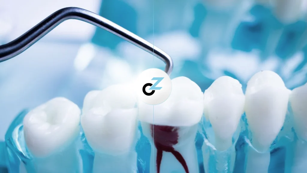 Tratamento de Canal: Como É Feito e Quais as Vantagens