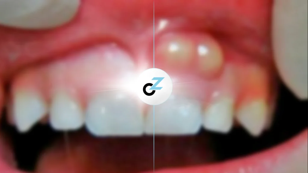 Abcesso Dentário: O Que É, Causas e Como Tratar