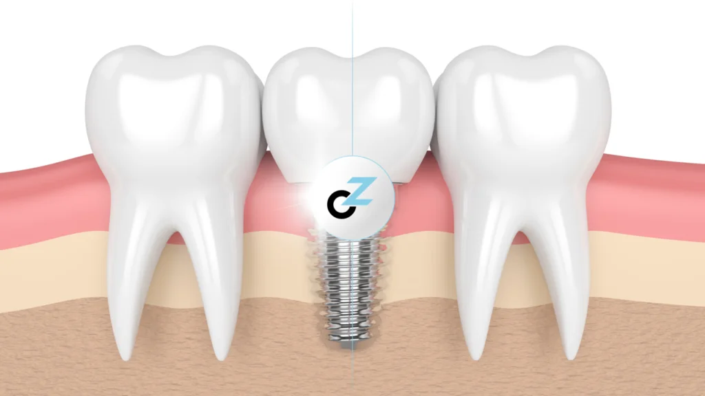 Colocar Implante Dentário: o que é preciso?