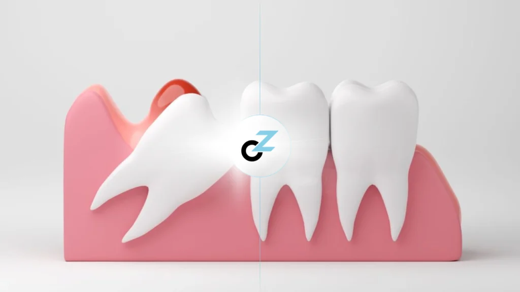 Pericoronarite: Causas, Sintomas e Tratamento