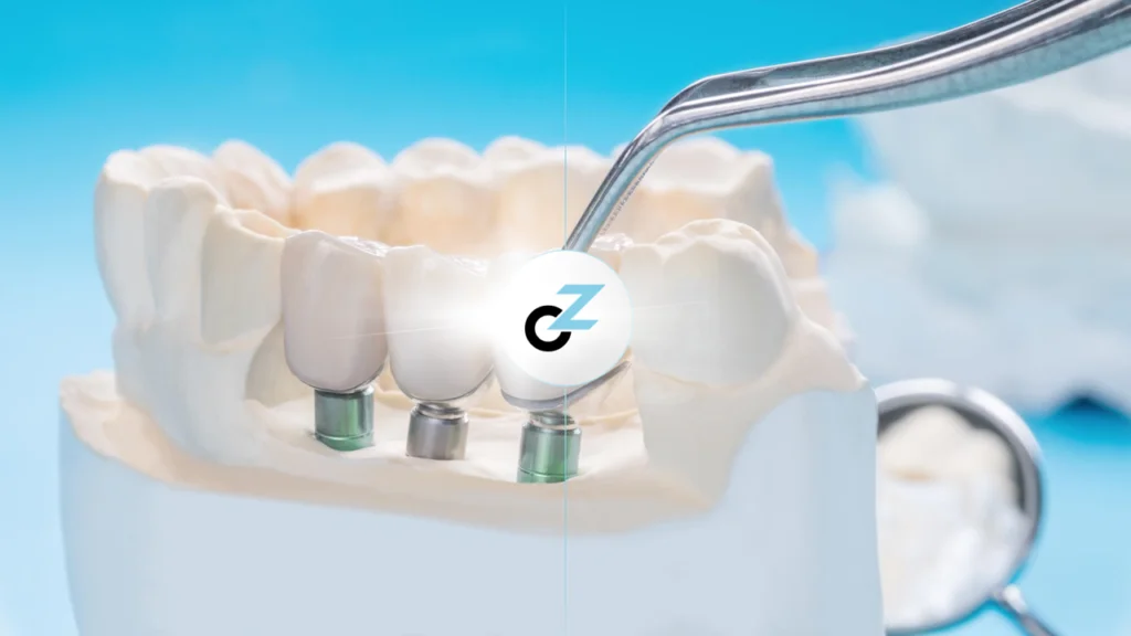 Tipos de Implante Dentário: conheça todas as opções