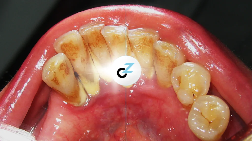 Tártaro Dentário: O Que É e Como Remover Corretamente