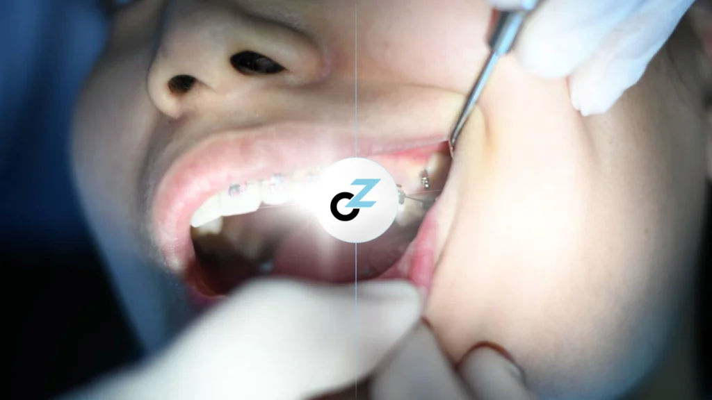 Usar Aparelho Novamente: por que os dentes entortam?