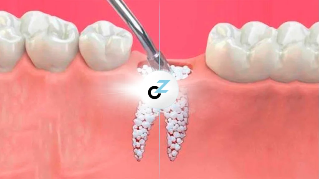 Enxerto Ósseo Dentário: o que é e como funciona?