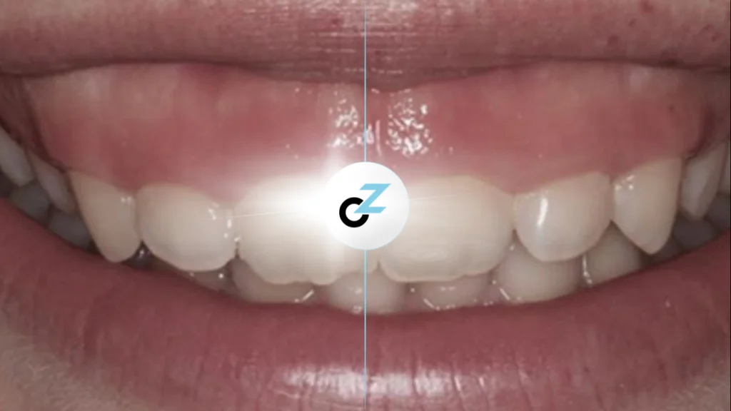 Gengivoplastia: Indicações, Benefícios e Recuperação