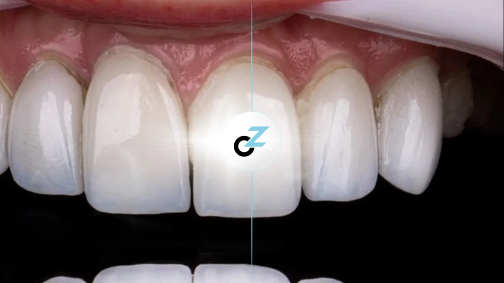 Lentes de Contato Dental: como funciona e cuidados