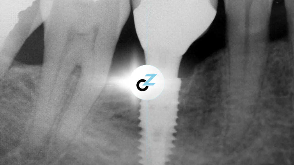 Implante Dentário: Mitos e Verdades que Você Precisa Saber
