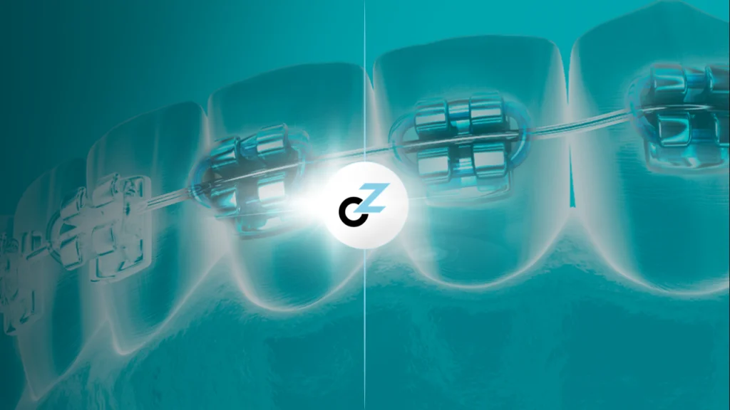 Tipos de Aparelho Ortodôntico: conheça os 5 principais