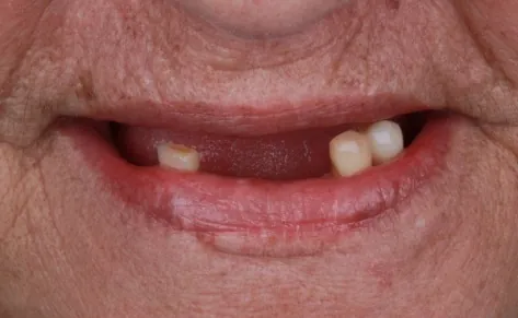 Antes do implante dentário - OdontoZ