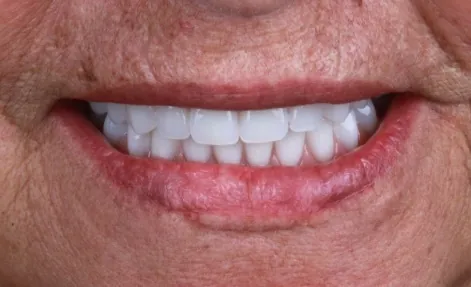 Depois do implante dentário - OdontoZ