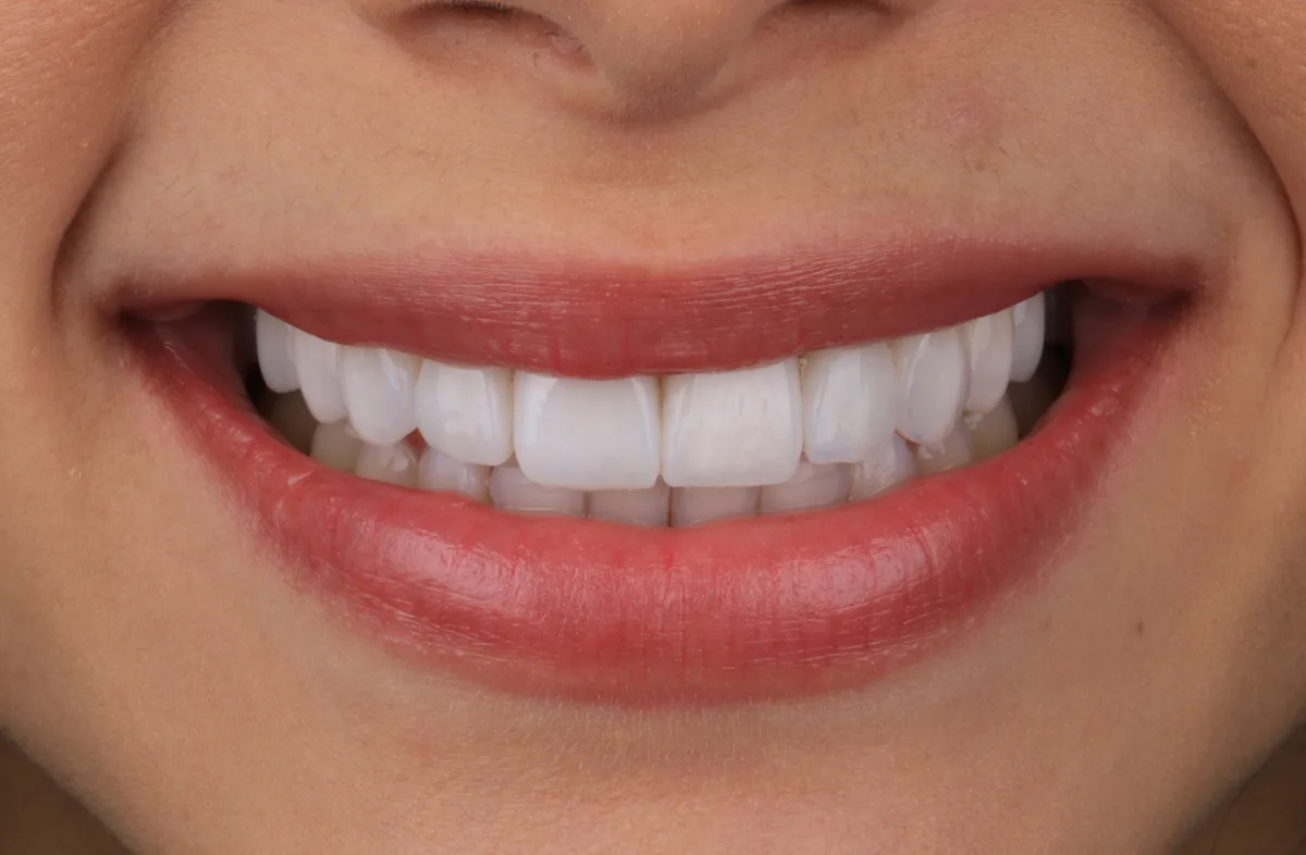 Sorriso da Ruth depois das lentes de contato dentais