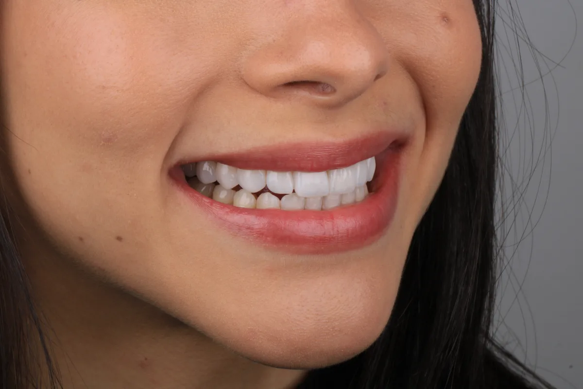Sorriso da Ruth após lentes de contato dentais - vista lateral direita