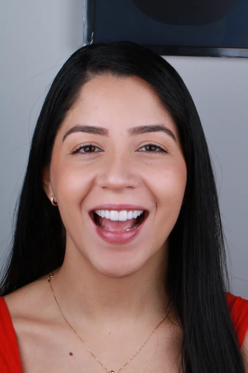 Jéssica mostrando o resultado das facetas de porcelana - boca aberta