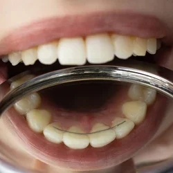 closeup-permanent-bonded-retainer-on-260nw-2131888195