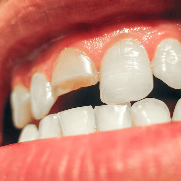 dente-quebrado-incisivo-superior-quebrado-na-boca-de-um-homem_120587-5121