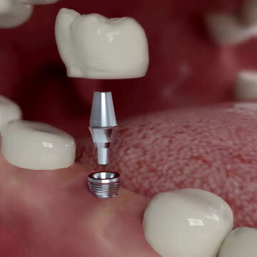 Dental Implant, Dental Equipment, Human Mouth, Teeth, Implant