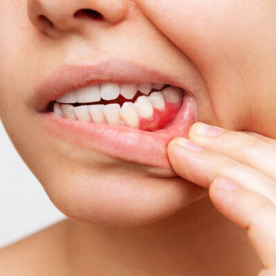 Gum inflammation. Cropped shot of a young woman showing red bleeding gums isolated on a white background. Close up. Dentistry, dental care