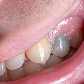 A dark tooth in a man's mouth after injury. Tooth decay by caries, dentistry.