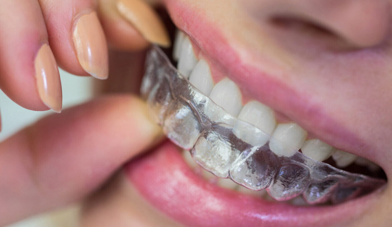mulher-usando-aparelho-invisivel-de-silicone-ortodontico