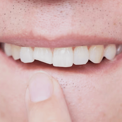 os-dentes-quebrados-masculinos-danificaram-o-dentista-dianteiro-rachado-da-necessidade-do-dente-para-fixar-e-reparar_43300-354